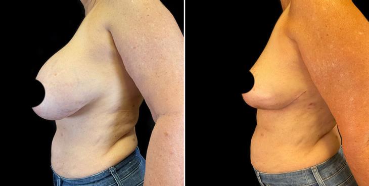 Implant Removal Results